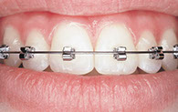 BRACKETS, BREKKIS, BRÄKES, BRIKKIS, BREKETS, BRECKITS